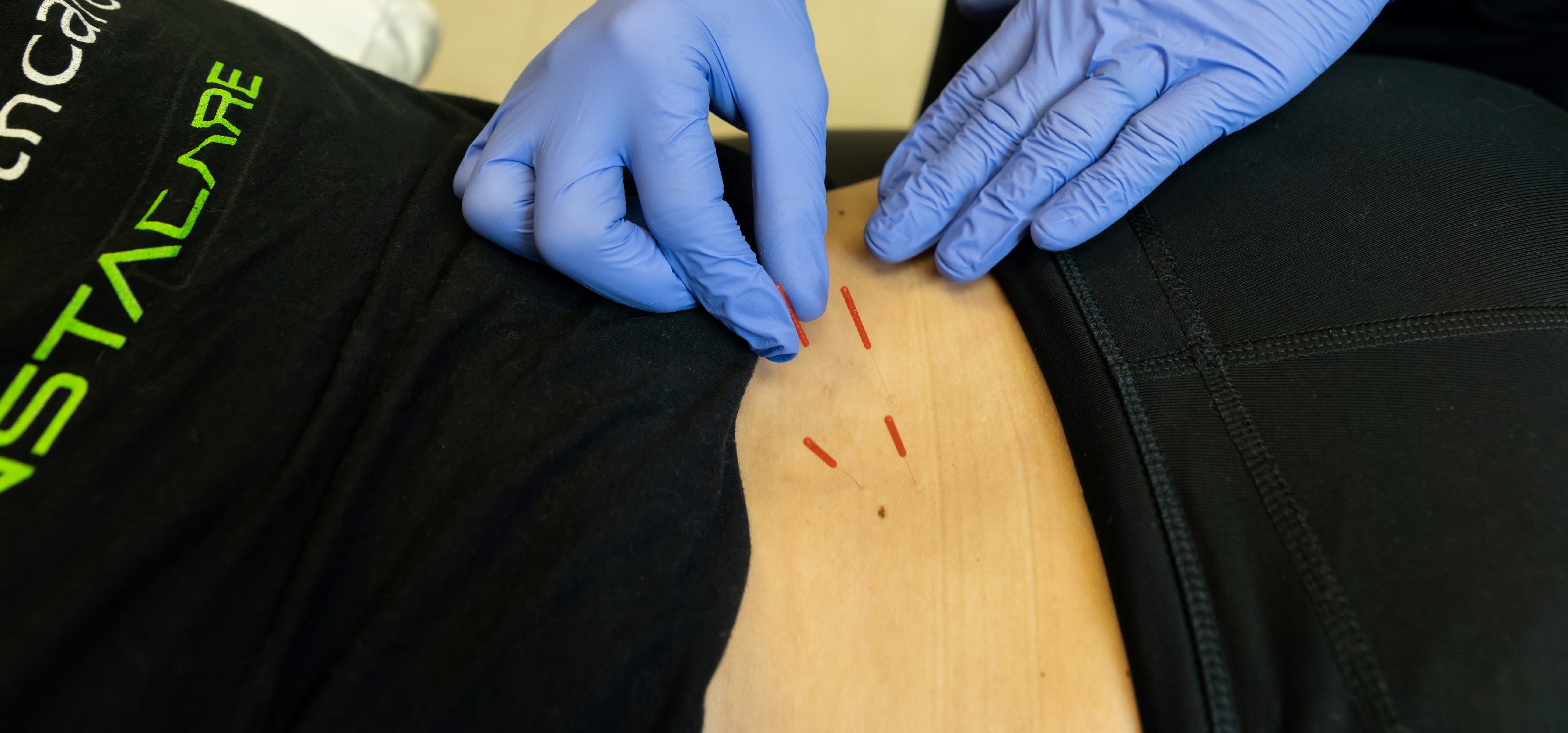 Dry needles placed along a patient's lower back