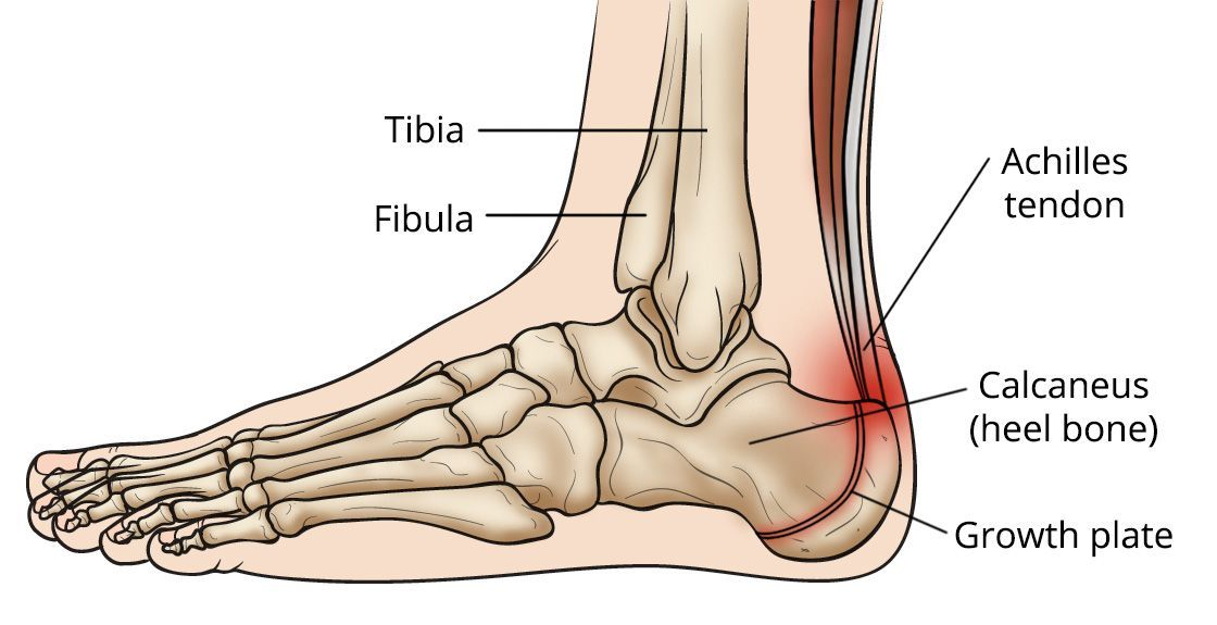 Diagram of the heel showing the Achilles tendon and growth plate